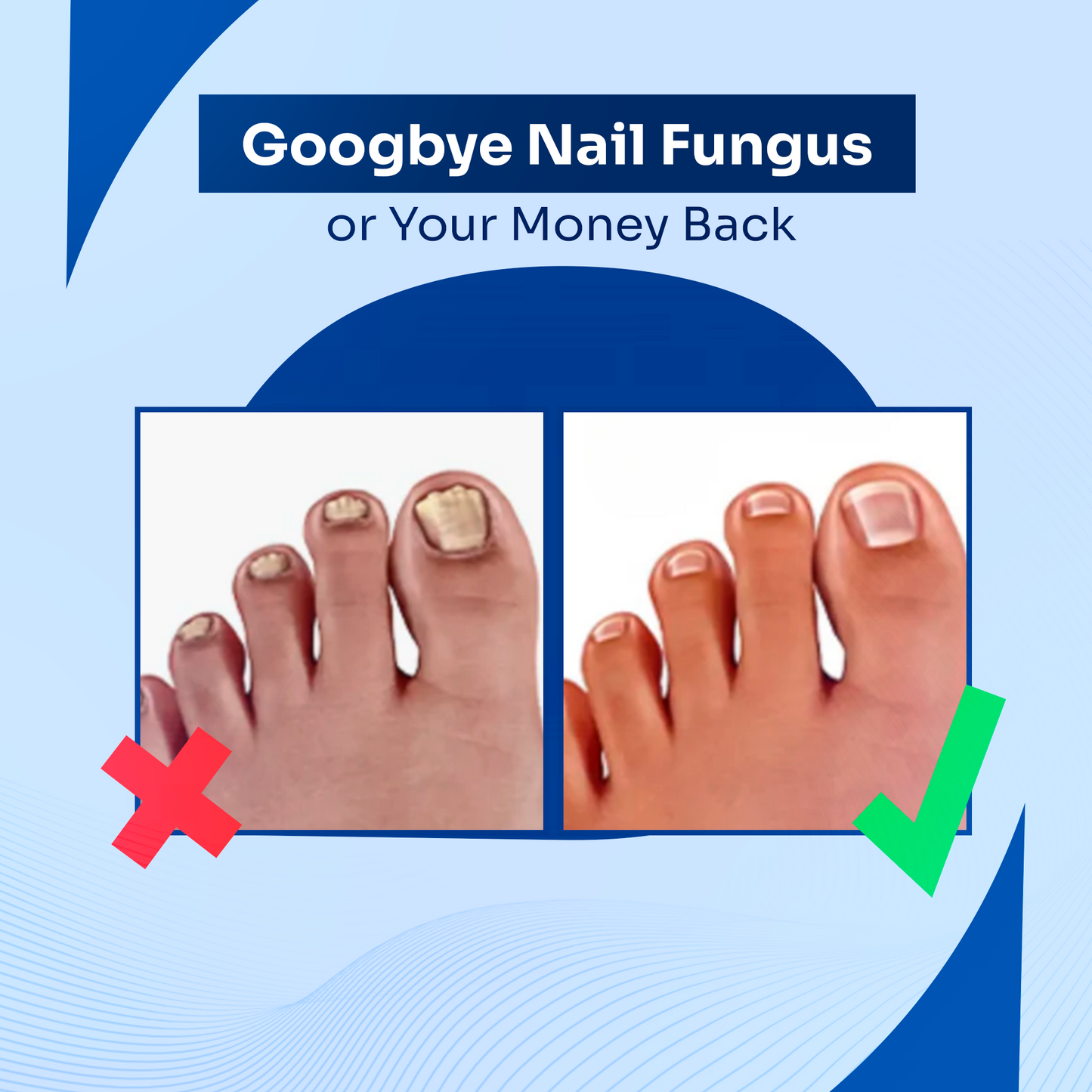 DermalPulse™ Nail Fungus Treatment